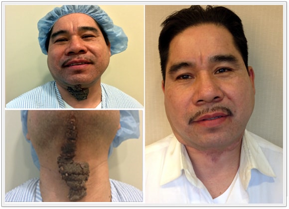 congenital nevus removal before and after